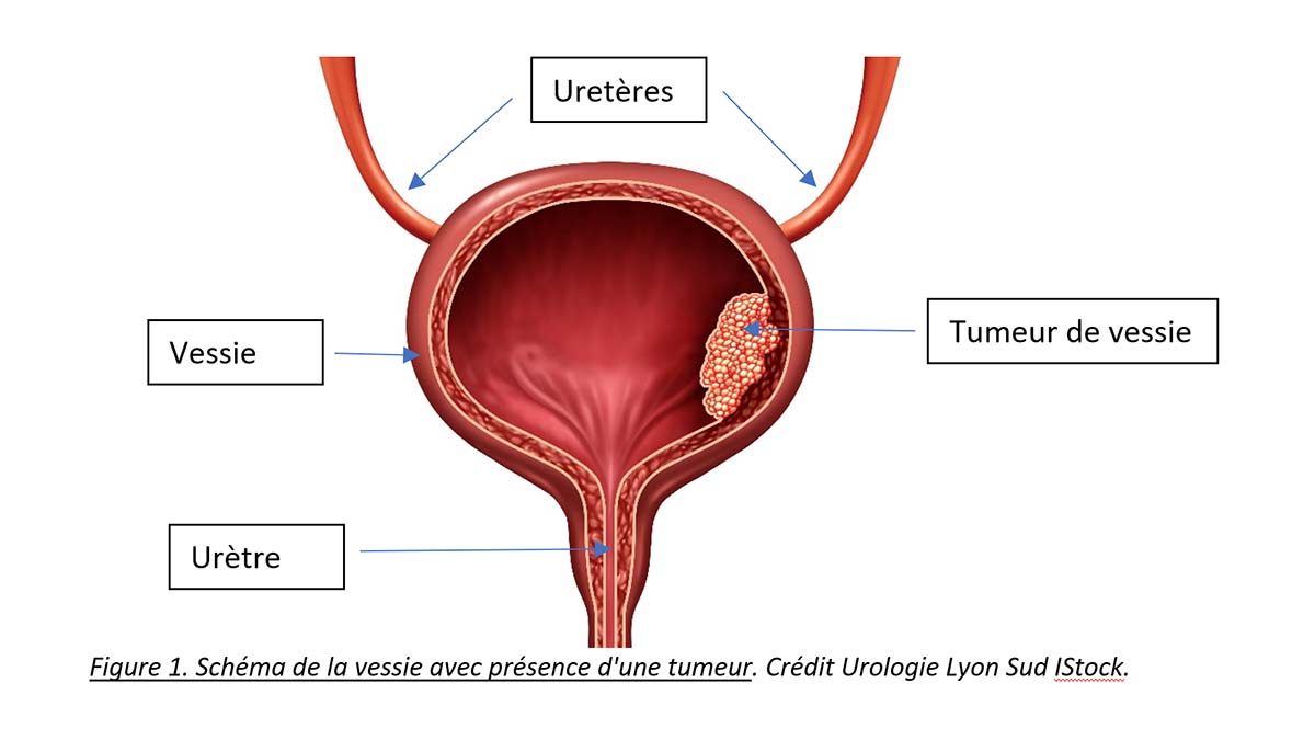 cancer de la vessie